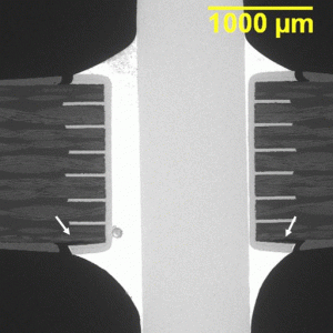 This is a plated thru hole (PTH) solder joint where the land on the solder side of the board has lifted due to a combination of excessive z-axis expansion of the laminate during wave solder and shrinkage stress in the solder fillet on cool down.